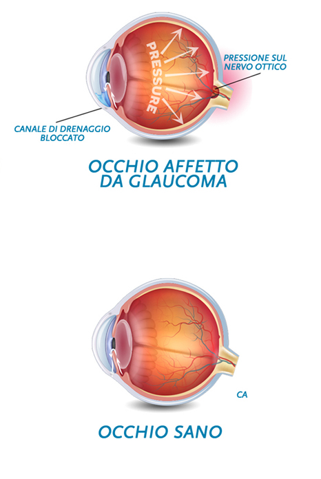 Glaucoma